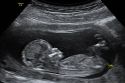 Proponen protocolos de atenci&oacute;n a madres y padres para enfrentar proceso de duelo por p&eacute;rdida perinatal o neonatal